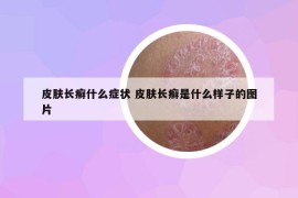 皮肤长癣什么症状 皮肤长癣是什么样子的图片