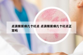 点滴银屑病几个红点 点滴银屑病几个红点正常吗