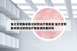 复方甘草酸单胺注射剂治疗银屑病 复方甘草酸单胺注射剂治疗银屑病效果好吗