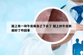 腿上有一块牛皮癣自己下去了 腿上的牛皮肤癣好了咋回事