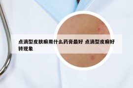 点滴型皮肤癣用什么药膏最好 点滴型皮癣好转现象