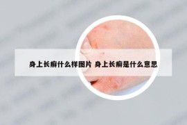 身上长癣什么样图片 身上长癣是什么意思