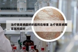 治疗银屑病最好的医院在哪里 冶疗银屑病那家医院最好