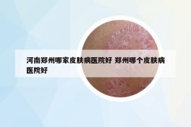 河南郑州哪家皮肤病医院好 郑州哪个皮肤病医院好