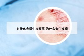 为什么会得牛皮顽屑 为什么会牛皮廨