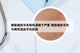 银屑病关节炎和风湿哪个严重 银屑病关节炎与类风湿关节炎区别