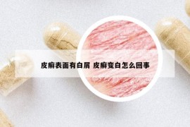 皮癣表面有白屑 皮癣变白怎么回事