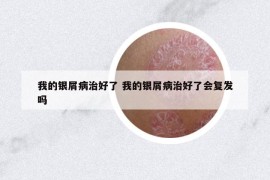 我的银屑病治好了 我的银屑病治好了会复发吗