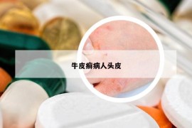 牛皮癣病人头皮