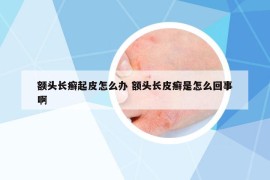 额头长癣起皮怎么办 额头长皮癣是怎么回事啊