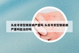 头皮寻常型银屑病严重吗 头皮寻常型银屑病严重吗能治好吗