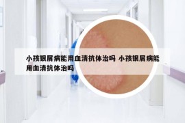 小孩银屑病能用血清抗体治吗 小孩银屑病能用血清抗体治吗