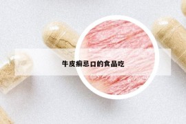 牛皮癣忌口的食品吃