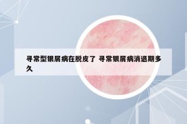 寻常型银屑病在脱皮了 寻常银屑病消退期多久