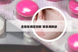 患银屑病扭到脚 银屑病脚部