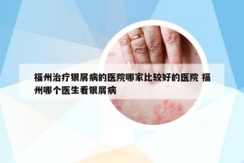 福州治疗银屑病的医院哪家比较好的医院 福州哪个医生看银屑病