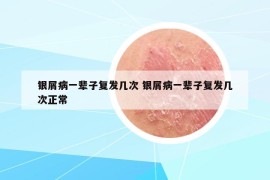 银屑病一辈子复发几次 银屑病一辈子复发几次正常