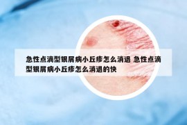 急性点滴型银屑病小丘疹怎么消退 急性点滴型银屑病小丘疹怎么消退的快