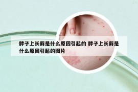 脖子上长藓是什么原因引起的 脖子上长藓是什么原因引起的图片