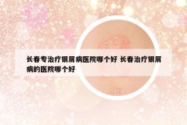 长春专治疗银屑病医院哪个好 长春治疗银屑病的医院哪个好