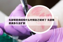 头部银屑病结痂什么时候自己就掉了 头部银屑病多久会扩散