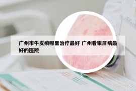 广州市牛皮癣哪里治疗最好 广州看银屑病最好的医院