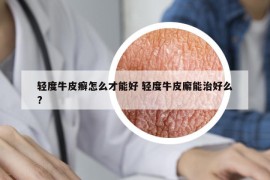 轻度牛皮癣怎么才能好 轻度牛皮廨能治好么?