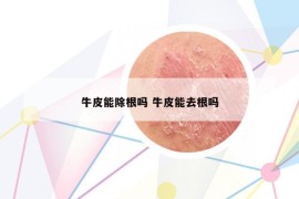 牛皮能除根吗 牛皮能去根吗