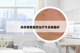 南京哪里医院治疗牛皮癣最好