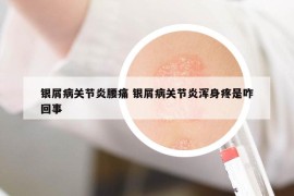 银屑病关节炎腰痛 银屑病关节炎浑身疼是咋回事