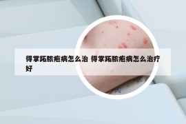 得掌跖脓疱病怎么治 得掌跖脓疱病怎么治疗好