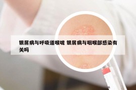 银屑病与呼吸道喉咙 银屑病与咽喉部感染有关吗