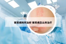 银霄病如何治好 银宵病怎么样治疗