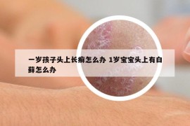 一岁孩子头上长癣怎么办 1岁宝宝头上有白藓怎么办