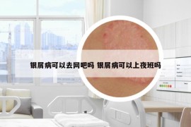 银屑病可以去网吧吗 银屑病可以上夜班吗