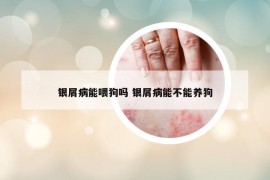 银屑病能喂狗吗 银屑病能不能养狗