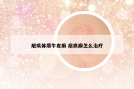 疤痕体质牛皮癣 疤痕癣怎么治疗