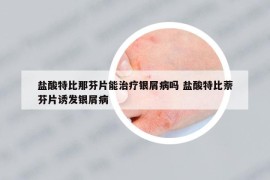 盐酸特比那芬片能治疗银屑病吗 盐酸特比萘芬片诱发银屑病