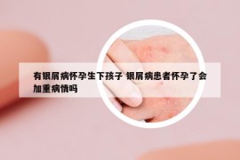 有银屑病怀孕生下孩子 银屑病患者怀孕了会加重病情吗