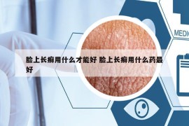 脸上长癣用什么才能好 脸上长癣用什么药最好