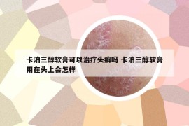 卡泊三醇软膏可以治疗头癣吗 卡泊三醇软膏用在头上会怎样