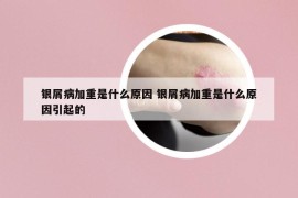 银屑病加重是什么原因 银屑病加重是什么原因引起的