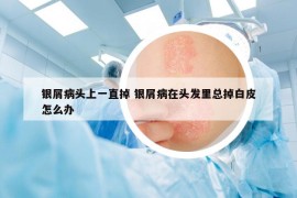 银屑病头上一直掉 银屑病在头发里总掉白皮怎么办