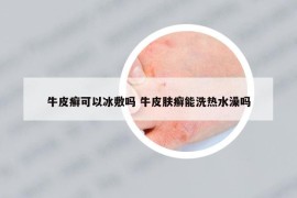 牛皮癣可以冰敷吗 牛皮肤癣能洗热水澡吗