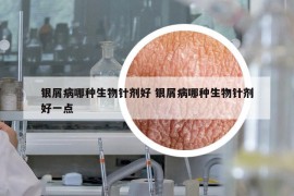 银屑病哪种生物针剂好 银屑病哪种生物针剂好一点