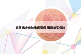 银屑病会增加承保费吗 银屑病买保险