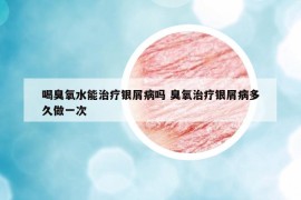 喝臭氧水能治疗银屑病吗 臭氧治疗银屑病多久做一次