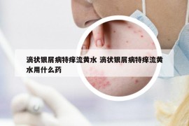 滴状银屑病特痒流黄水 滴状银屑病特痒流黄水用什么药