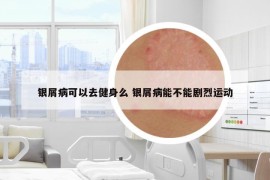 银屑病可以去健身么 银屑病能不能剧烈运动