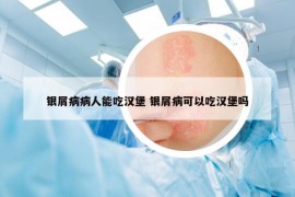 银屑病病人能吃汉堡 银屑病可以吃汉堡吗